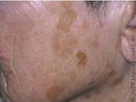 Discoloration - age spots on face